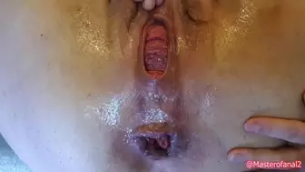 Preview - Extreme Anal and Prolapse